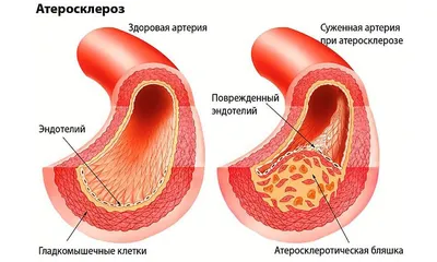 Ишемическая болезнь сердца: симптомы и проявления, советы врача по лечению  | Амадей Клиник