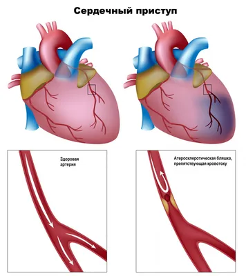 Ишемическая болезнь сердца (ИБС) - причины появления, симптомы заболевания,  диагностика и способы лечения