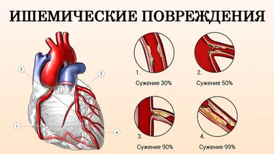 Ишемическая болезнь сердца (ИБС) – симптомы, лечение, диагностика