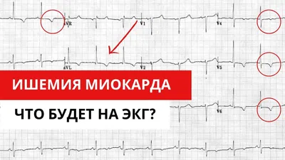 ИШЕМИЧЕСКАЯ БОЛЕЗНЬ СЕРДЦА - Трошенькина Ольга Владимировна