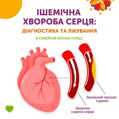 ⚕ Ишемическая болезнь сердца: диагностика и лечение - PULSE