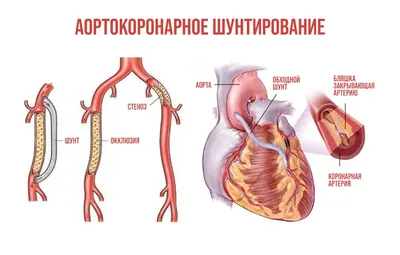 Лечение ишемической болезни сердца в пожилом возрасте