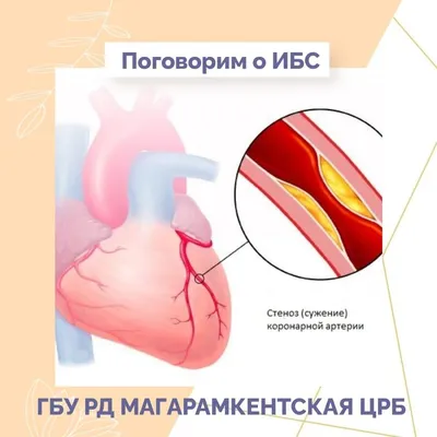 Ишемическая болезнь сердца: причины, симптомы, факторы риска, методы  диагностики и лечения