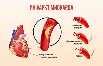Ишемическая болезнь сердца: на какие симптомы необходимо обратить внимание  - Новости МЦ «ЛОТОС»