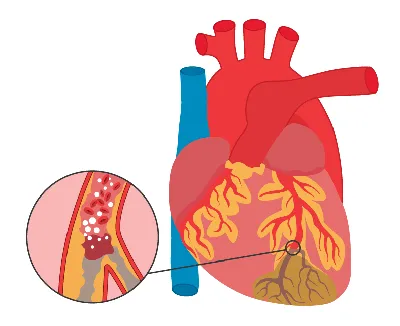 Ишемическая болезнь сердца (ИБС) — Твой Врач в Варшаве