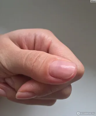 Фото грибка ногтей на руках у людей пожилого возраста и как его лечить