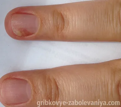 Грибок ногтей на руках: фото-подборка на разных стадиях заболевания