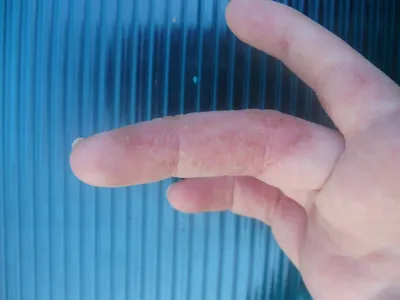 Изображение рук с экземой: как она влияет на кожу