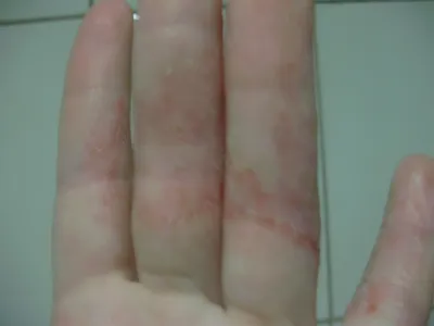 Фото рук с экземой: как выглядит заболевание