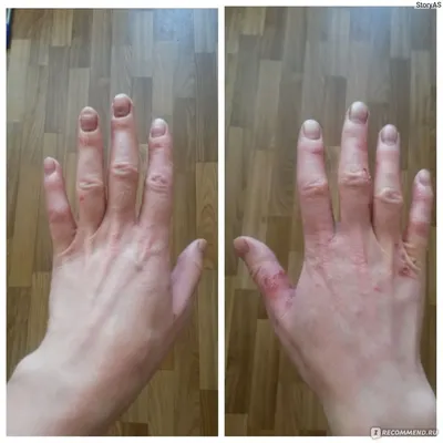 Как выглядит экзема на руках: фото до и после лечения