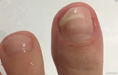 Изображения грибка на ногтях рук: какие признаки нужно учитывать