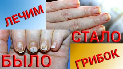Как определить грибок на ногтях рук: фото и советы