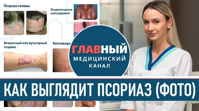 Картинка псориаза на руках в формате WebP