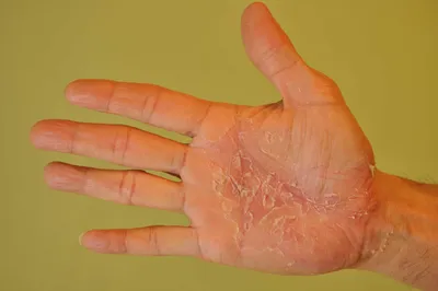 Фото псориаза на руках: примеры симптомов