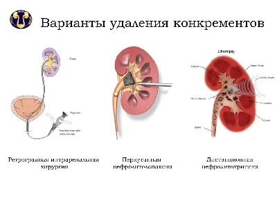 Статья «Камни в почках – симптомы» – Клиника Амариллис