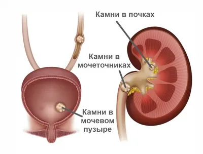 Камни в почках, все что нужно знать - UROSVIT