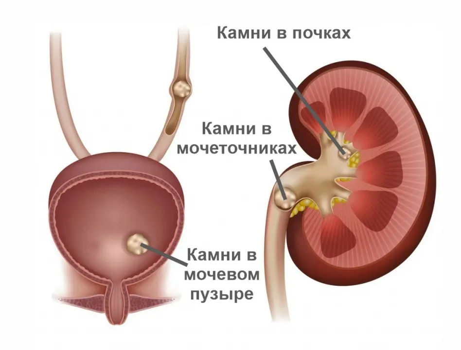 Мочекаменная болезнь конкременты. Почечно-каменная болезнь. Мочекаменная болезнь почечная колика. Образование камней в почках.