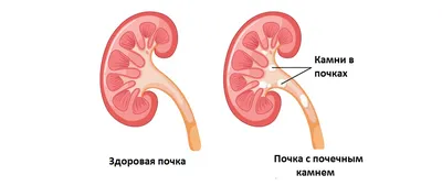 Камни в почках» — создано в Шедевруме