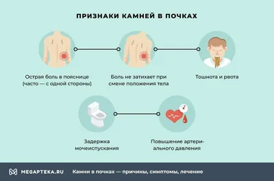 Камни в почках, все что нужно знать - UROSVIT