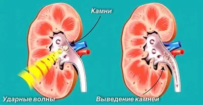 Удаление камней из почек: как проходит операция, сколько стоит, методы  удаления камней