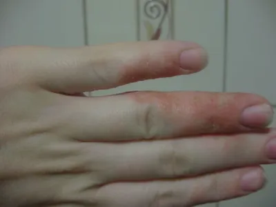 Кандидоз кожи рук: изображение для диагностики