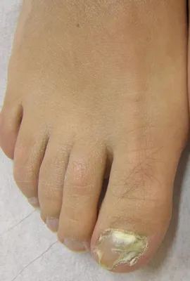 Кандидоз ногтей рук: фото высокого качества для диагностики