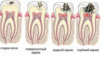 Лечение детского кариеса зубов в Минске: цены, отзывы