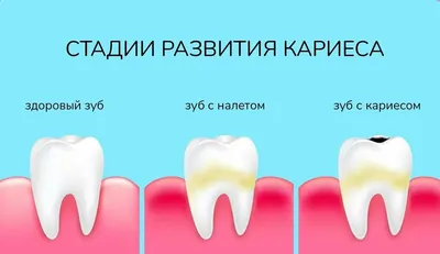 глубокий кариес у детей — sante