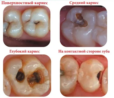 Лечение кариеса — цены в Москве | Damas Medical Center