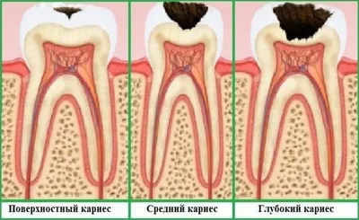 Кариес зубов — причины возникновения, стадии развития и факторы риска