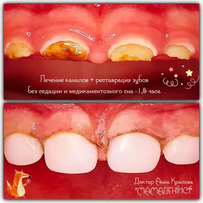 Кариес - это инфекционное заболевание! | Clínica Dental Moreno-Montalvo