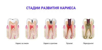 В какие случаях под пломбой возникает кариес – Немецкий имплантологический  центр, Москва