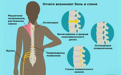 Боль в спине между лопатками – что делать? | Med-magazin.ua - cеть  магазинов медтехники