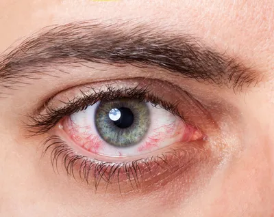 Глаза в опасности. Что собой представляет герпетический кератит? | Здоровая  жизнь | Здоровье | Аргументы и Факты