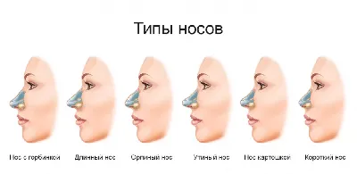 Контурная пластика носа в Израиле - Доктор Эли Шульман - коррекция формы  носа