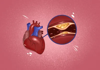 Может ли болеть сердце? | Блог о здоровье «Рэмси Диагностика»