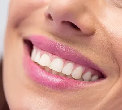 Идеальная улыбка - фото, стоматология, как сделать, сколько стоит.