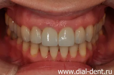 Улыбка с зубами до и после отбеливания. Стоковое Изображение - изображение  насчитывающей яркое, зубоврачебно: 183172799