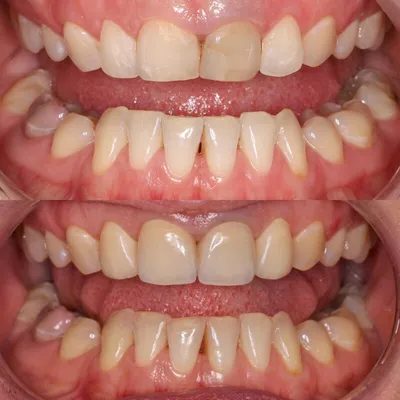 красивая женская улыбка с белыми прямыми зубами. Стоковое Изображение -  изображение насчитывающей зубоврачевание, пациент: 223391425