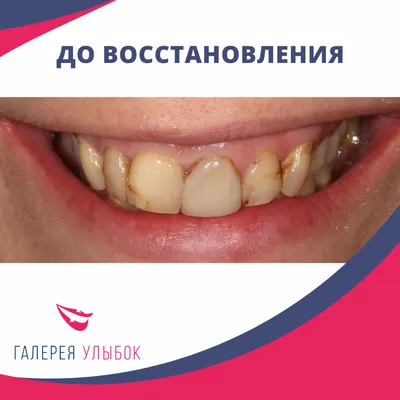 Страшные зубы в зоне улыбки остались в прошлом! - Стоматологическая клиника  Лазурит