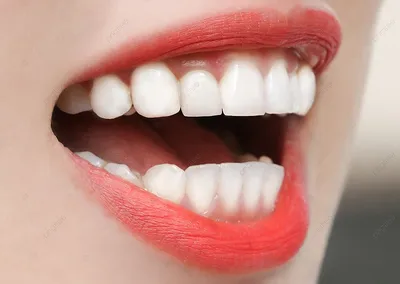 Улучшение улыбки: от лечения брекетами до протезирования передних зубов