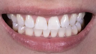 мужская улыбка показана с отсутствующими зубами и зубами, фото людей с  зубными протезами фон картинки и Фото для бесплатной загрузки