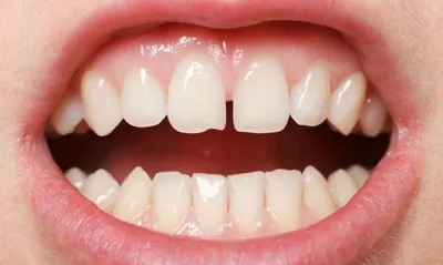 Что делать, чтобы были красивые зубы