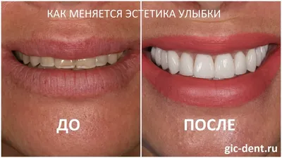 Улыбка – самой важное фото в процессе лечения! - интересно об ортодонтии,  имплантации и протезировании зубов