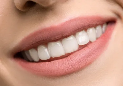 Улучшите улыбку после отбеливания Зубы зубоврачебной заботы и забеливать  Улыбка женщины с большими зубами Конец-вверх улыбки с бе Стоковое  Изображение - изображение насчитывающей женщина, смех: 59846035