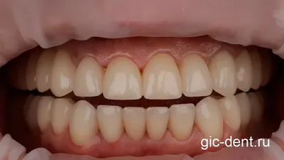 Отбеливание зубов - ЛИНИЯ УЛЫБКИ