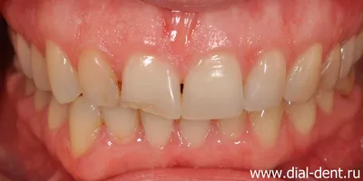 Виниры на зубы - эстетика улыбки фото до и после Мытищи — Мытищи цена и  отзывы стоматологии Best Family