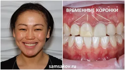Секреты белоснежной улыбки: отбеливание зубов | Клиника бережной  стоматологии \"Атмосфера\" | Дзен