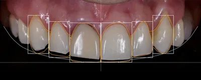 Как убрать щель между передними зубами – советы стоматологов | «Фактор  улыбки»