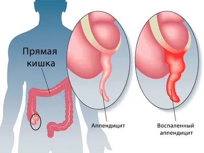 Острый аппендицит - диагностика и лечение в Москве. Консультация врача.